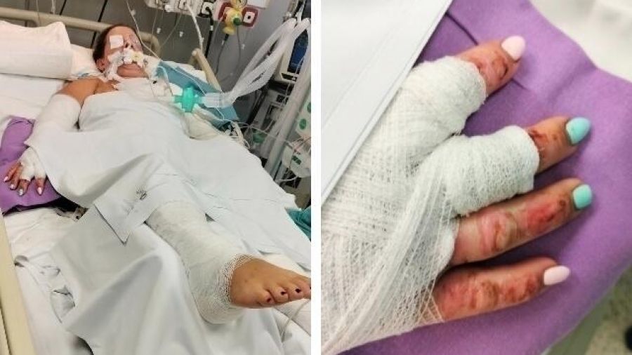 Poparzona 36-letnia Nina Komisarek z Borzykowa, Siepomaga, zbiórka (fot. SiePomaga)