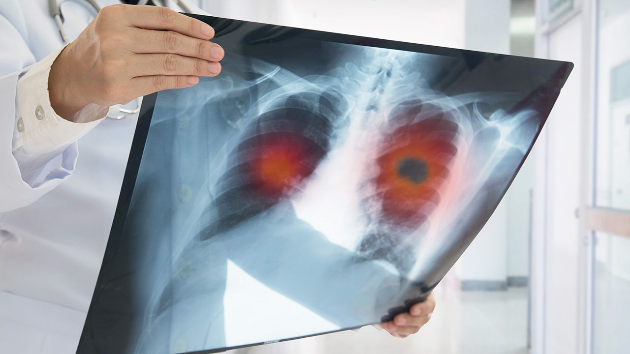 Belgowie udowodnili, że nanocząsteczki miedzi są skuteczne w walce z nowotworami (fot. Shutterstock/tumor)