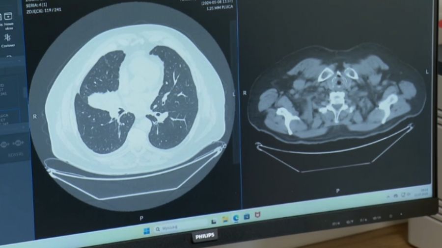 Diagnostyka raka płuc w jeden dzień. W Czerwonej Górze powstaje pierwszy taki ośrodek w Polsce