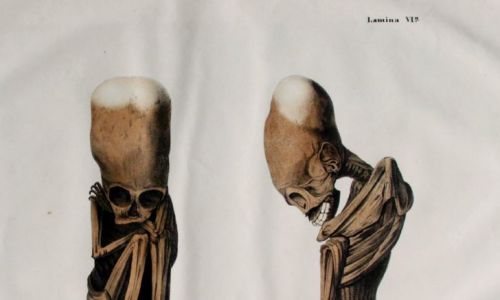 Dr Leopold Müller: Litografia płodu, w pozycji wewnątrzmacicznej, z typowym kształtem czaszki Huanca, hiszpańskiej wersji 